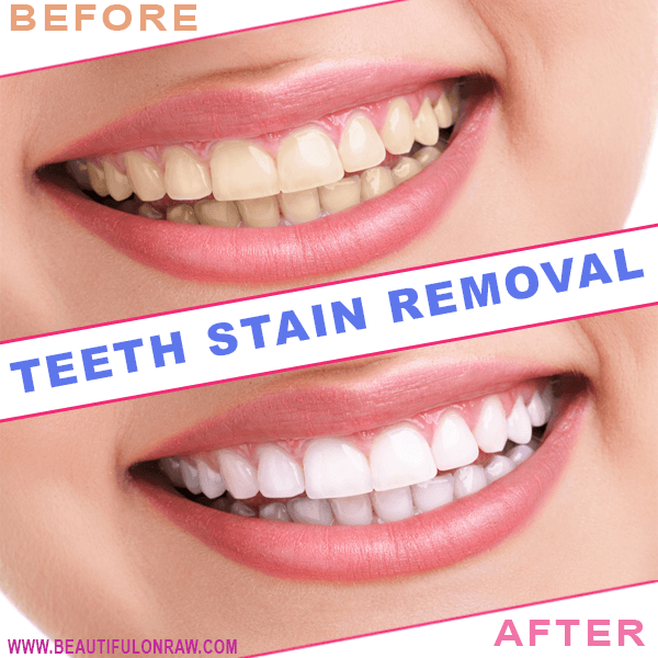 Teeth Staining Removal Beautiful On Raw